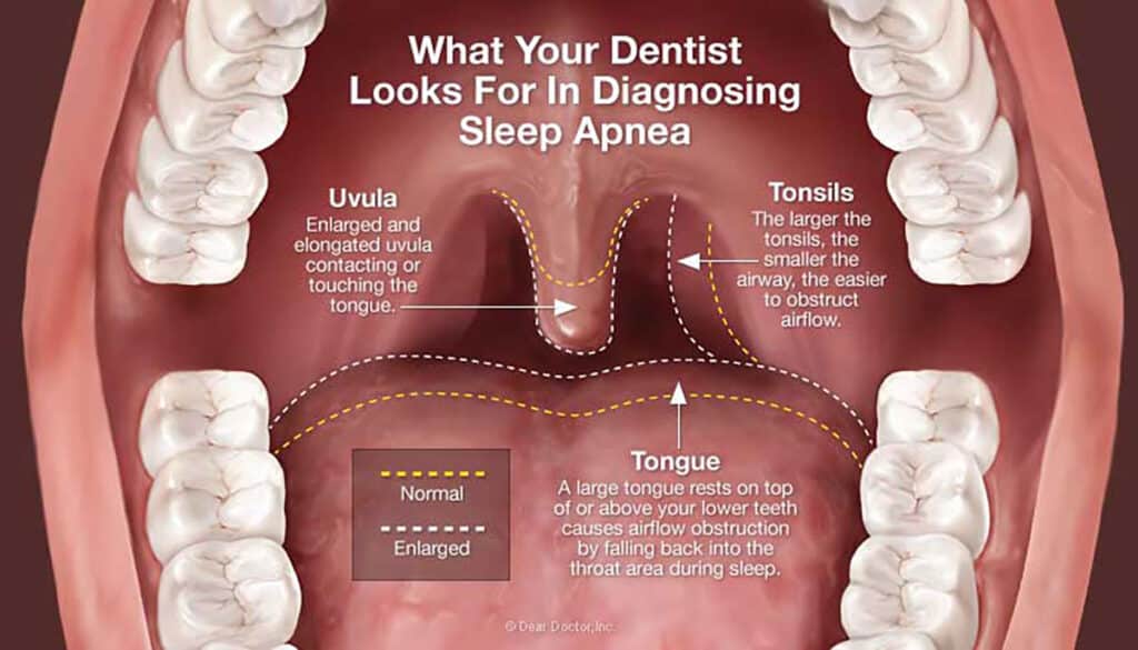 Diagnosing Sleep Apnea 1024X585 1