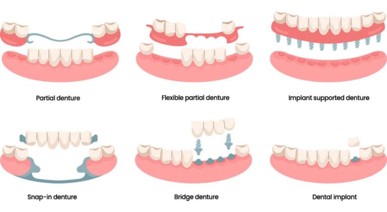 Types Of Dentures2 1024X561 1