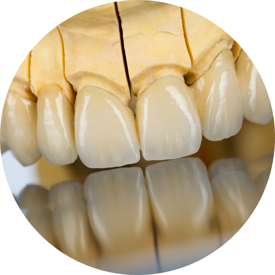 What Are Dental Bridges