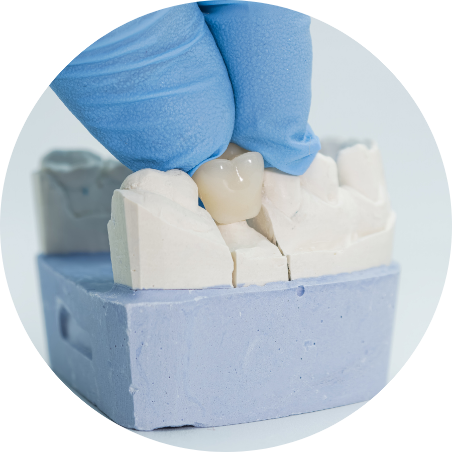 What Are Dental Crown