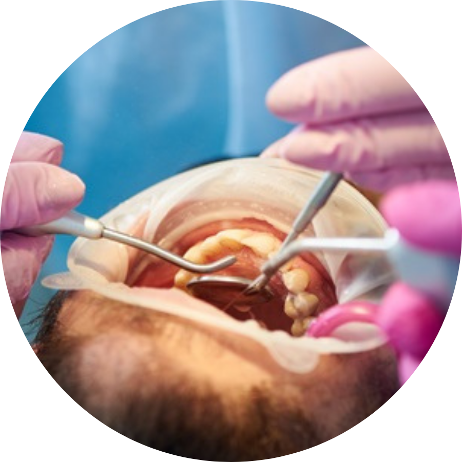 What Is Root Canal Treatment